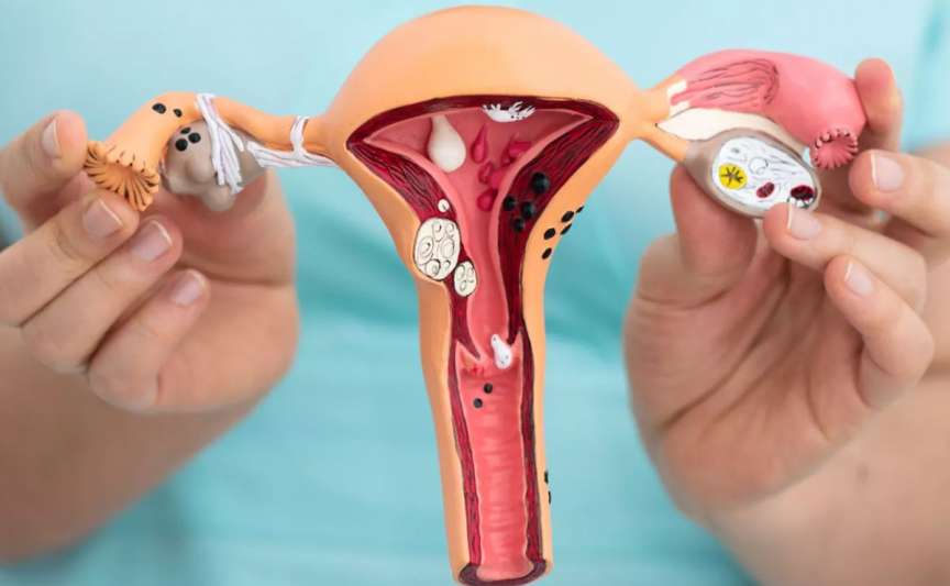 Endometrioza: ce este, cum se tratează și ce trebuie să știe fiecare femeie