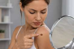 Melanomul: de ce apare acest tip de cancer de piele și cum te poți proteja