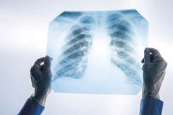 Screening pulmonar gratuit la Bălți: program pentru 5-9 octombrie