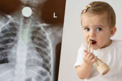 Copilul se sufocă cu un obiect: pașii care contează când fiecare minut contează
